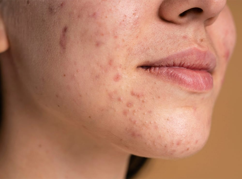 Dermatólogo en Santiago de Compostela acné